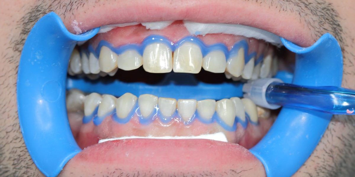 sbiancamento dentale dentista cherasco